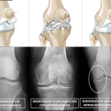 Frattura del ginocchio