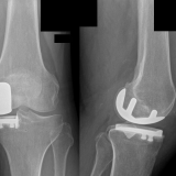 Protesi di ginocchio